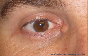Eyelid Lesion