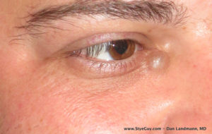 Eyelid Cyst At Corner of Eye.