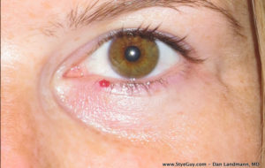 Lower Eyelid Lesions