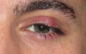 Lid Lesions On The Upper Eyelid.