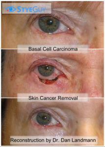 Basal Cell Carcinoma Removal and Reconstructive Surgery.