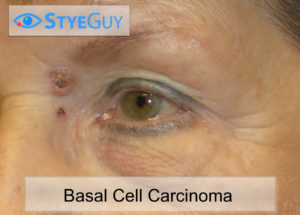 Basal Cell Carcinoma Near the Eye.