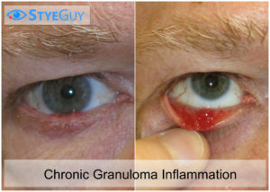 Chronic Granuloma Inflammation.