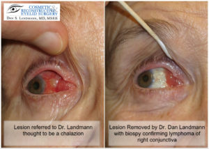 Lymphoma Lesions Of The Eye.
