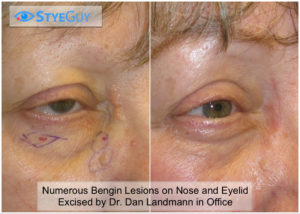 Surgical Removal of Benign Lesions From Around The Eyelid. 