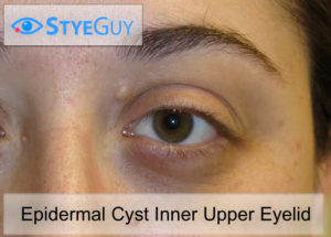 Epidermal Cyst Around Upper Eyelid.
