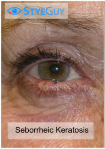 Eyelid lesion consistent with Seborrheic Keratosis.
