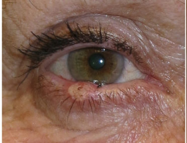 Stye Photos, Eyelid Lesion, Eyelid Skin Cancer | The StyeGuy