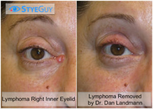 Removal of Lymphoma of The Eyelid.