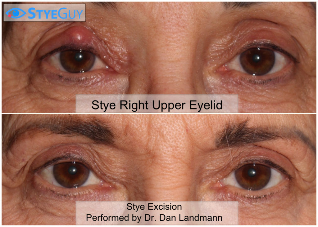 Excision Of A Stye On The Upper Eyelid Styeguy 