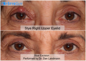 A Surgically Removed Stye From Upper Eyelid. 