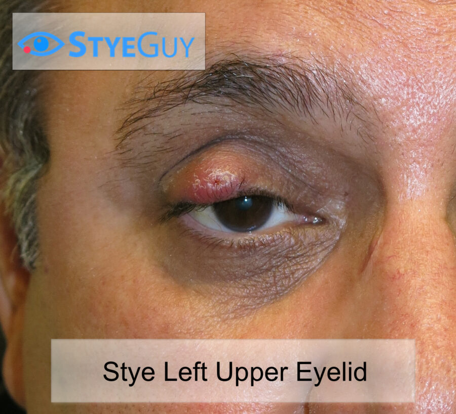 Collection 104+ Images how to apply stye ointment on upper eyelid Completed