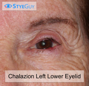 A Chalazion Cyst In The Eyelid