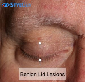 Multiple Benign Lesions On The Eyelid.