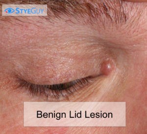 A Benign Eyelid Lesion Near The Caruncula
