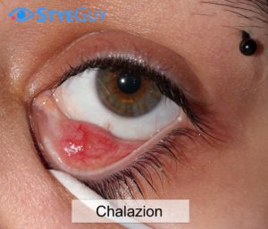 Lower Eyelid Chalazion Cyst.