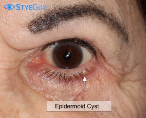 Epidermoid Cyst On Lower Eyelid.