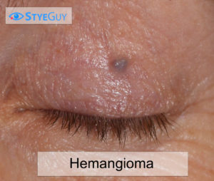 Small Hemangioma Growth