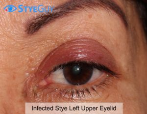 Infected Stye On Eyelid