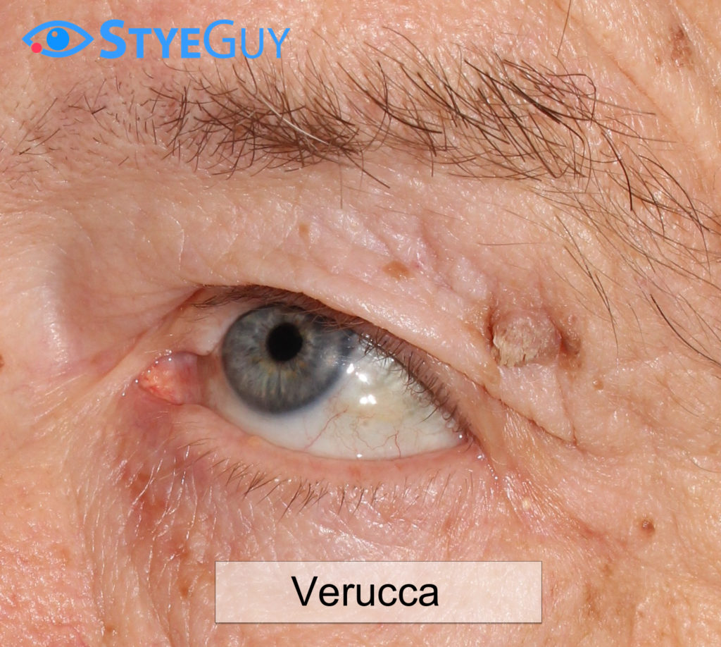 Verruca On Upper Eyelid | StyeGuy