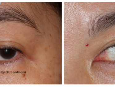 Stye Photos, Eyelid Lesion, Eyelid Skin Cancer | The StyeGuy