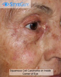 Squamous cell carcinoma around the eyes. 