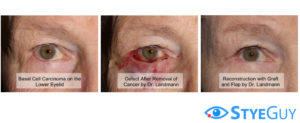 Reconstructive Surgery For Basal Cell Carcinoma.