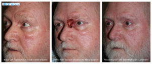 Basal Cell Carcinoma Excision and Reconstruction