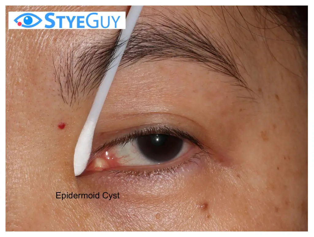 Stye Guy Epidermoid Cyst 