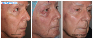 Basal Cell Carcinoma Removal