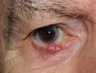 Eye Stye Photos, Eyelid Lesions, Eyelid Skin Cancer | The StyeGuy