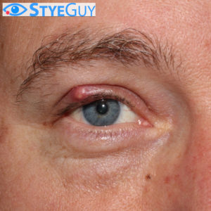 Upper Eyelid Stye
