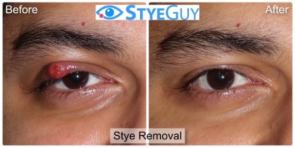Before and After Image Stye Removal at StyeGuy in River Edge, New Jersey.