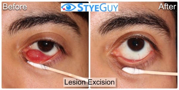Before and After Image Lesion Excision at StyeGuy in River Edge, New Jersey.