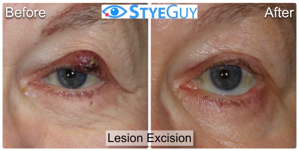 Before and After Image Lesion Excision at StyeGuy in River Edge, New Jersey.