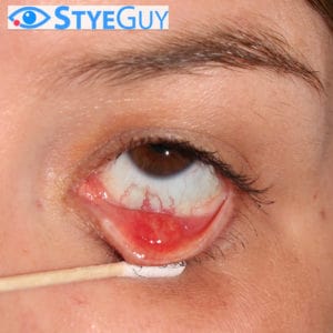 Image of Chalazion at StyeGuy in River Edge, New Jersey.