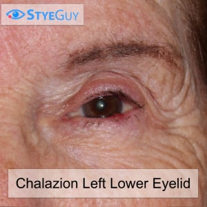 Image of Chalazion Left Lower Eyelid at StyeGuy in River Edge, New Jersey.
