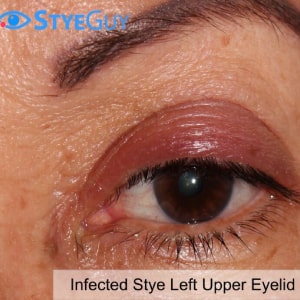 Image of Infected Stye Left Upper Eyelid at StyeGuy in River Edge, New Jersey.