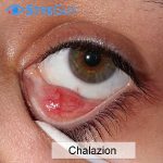 Stye Extraction Gallery | Before & After Photos | River Edge, NJ